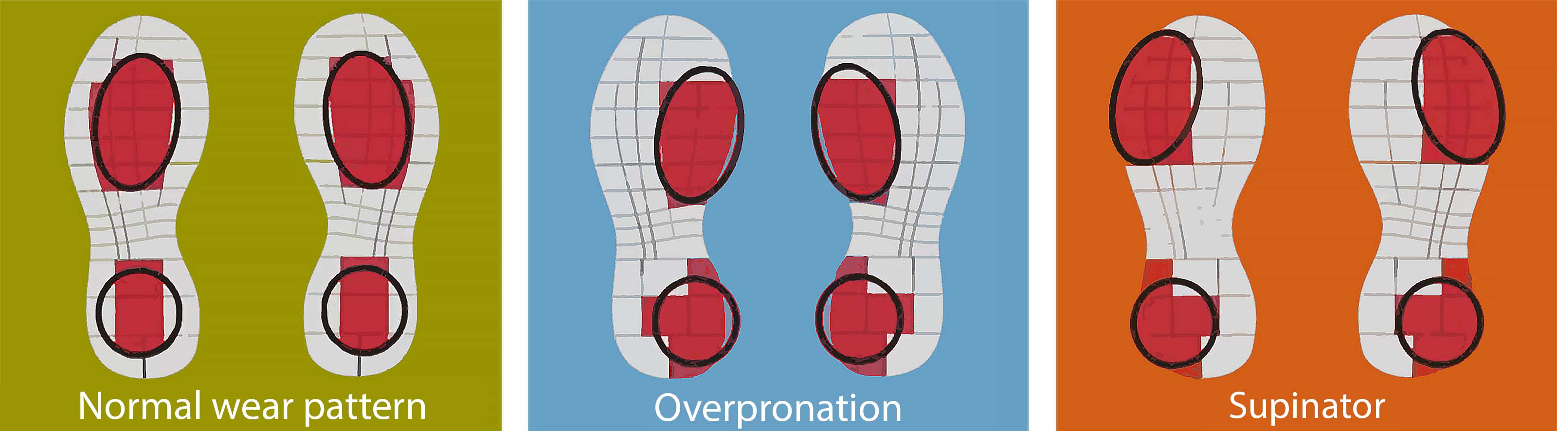 Shoe wear patterns showing normal wear, overpronation wear and supinator wear