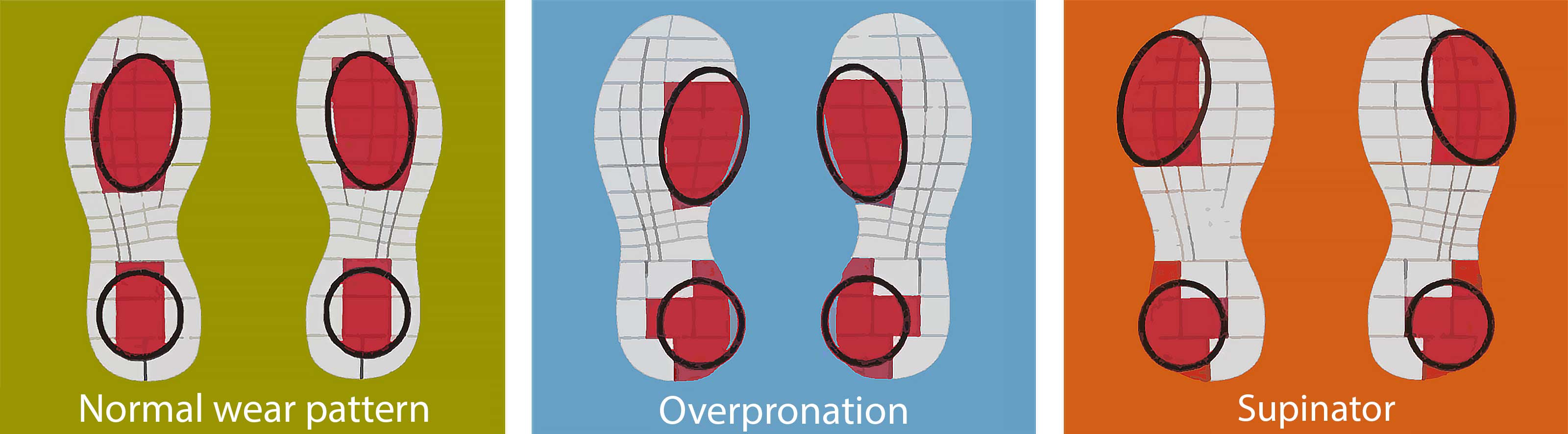 Understanding Overpronation: Why Do Your Shoes Wear Out on the Outside ...