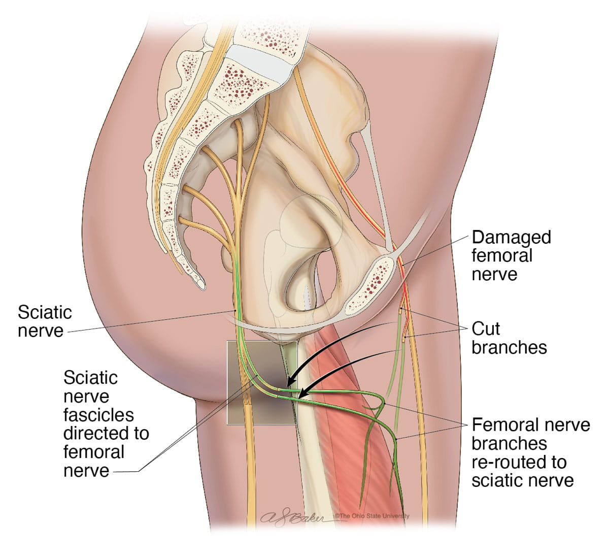 Rendering of a leg nerve transfer