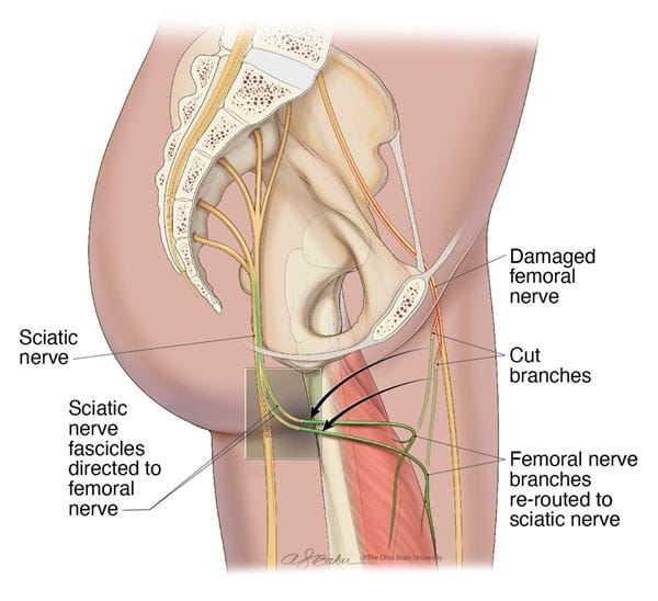 Rendering of a leg nerve transfer
