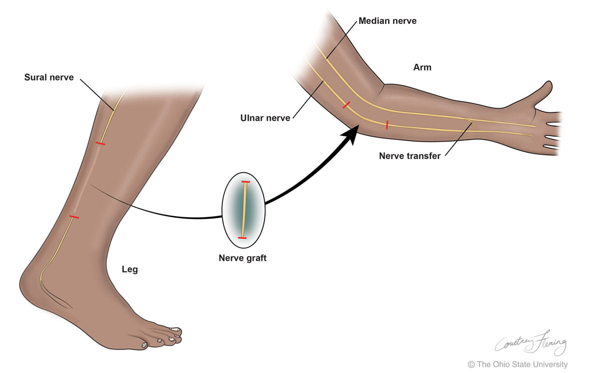 Rendering of a nerve from the leg being transferred to the arm