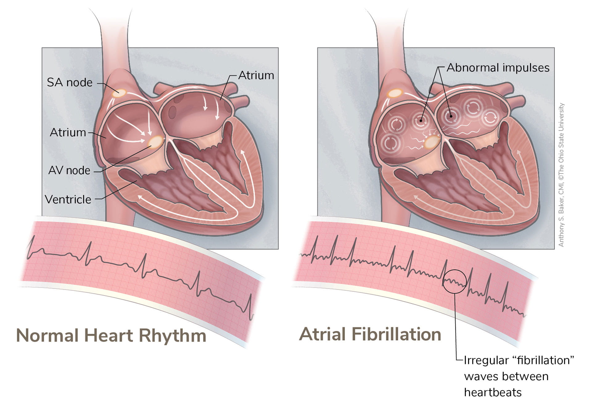 A diagram of a normal heart rhythm next to an irregular heart rhythm with "fibrillation" waves between heart beats