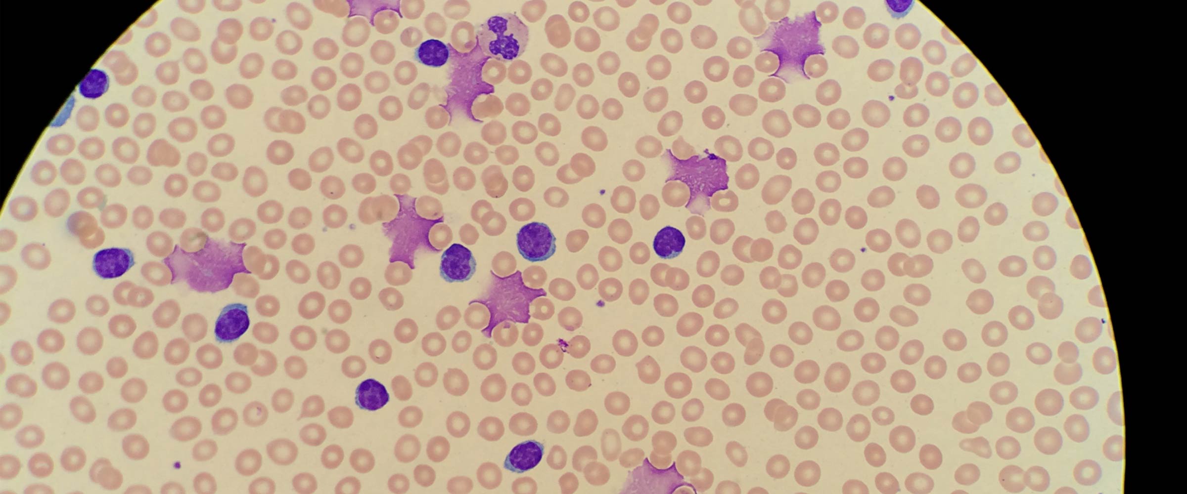 Chronic lymphocytic leukemia (CLL) cells under microscope