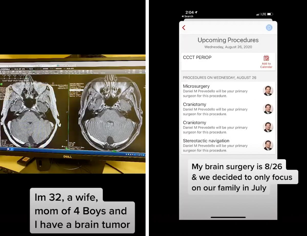 Tiktok posts showing a brain scan and a surgery scheduled