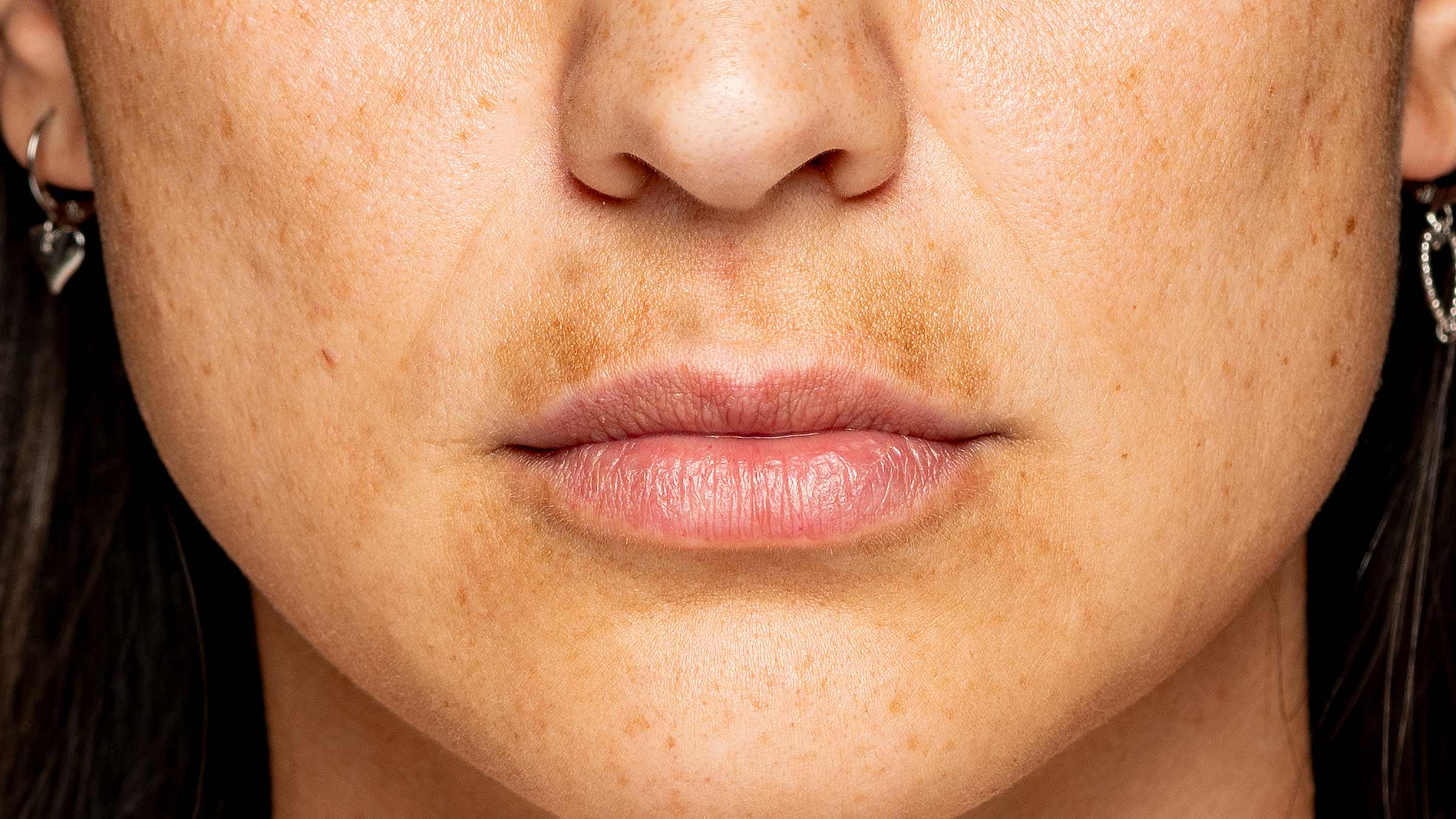 Woman with dark skin above lip, called Melasma Mustache