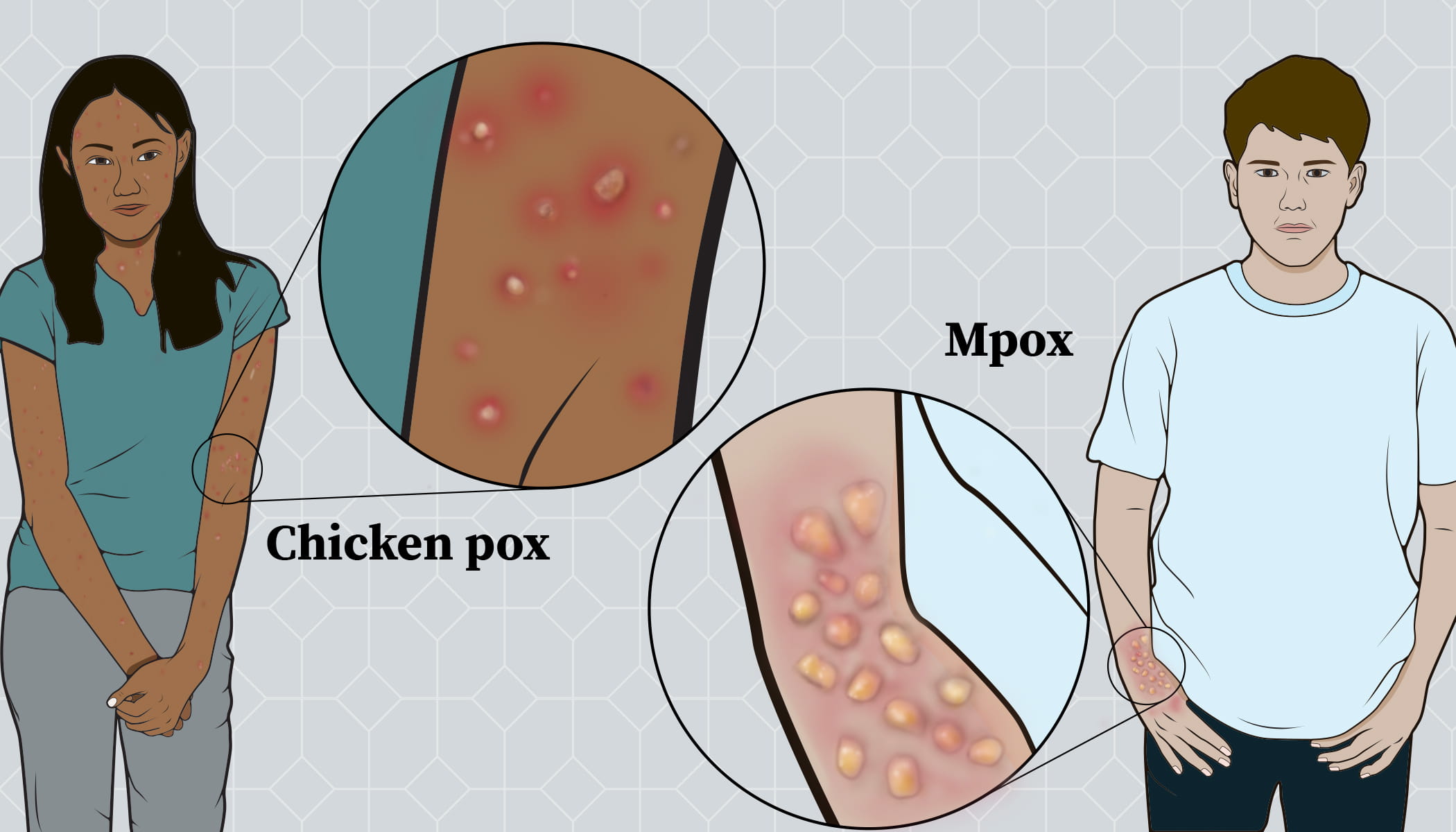 Illustration of a person with mpox sores and a person with chickenpox sores