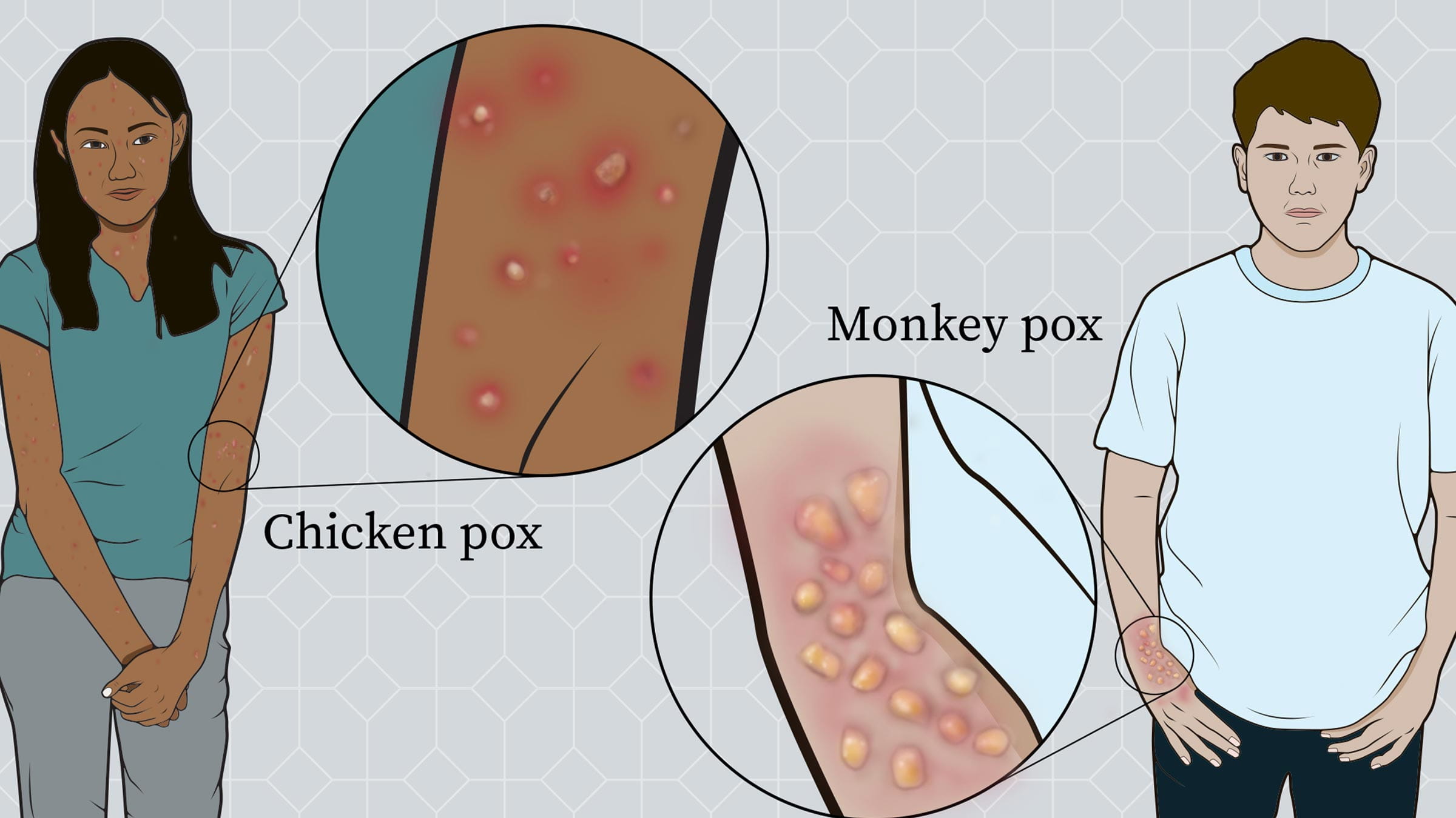 Illustration of a person with monkeypox sores and a person with chickenpox sores