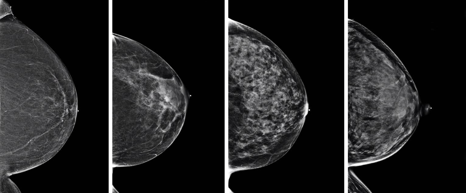 Four mammograms side by side with a different breast tissue density