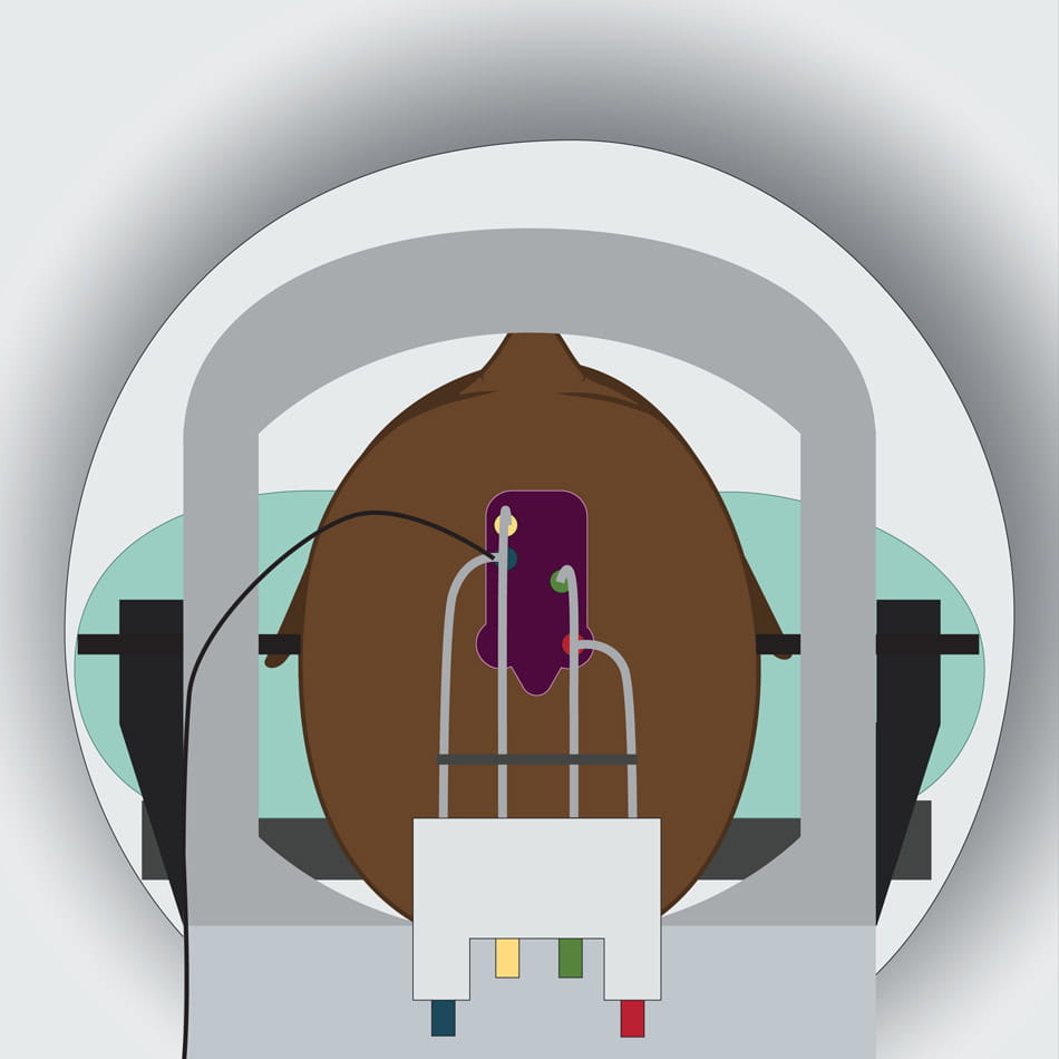 Gene therapy delivered through the skull