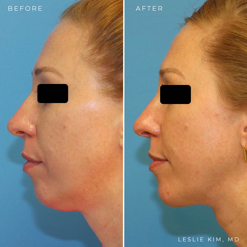 Before and after photos of one of Dr. Leslie Kim’s patients