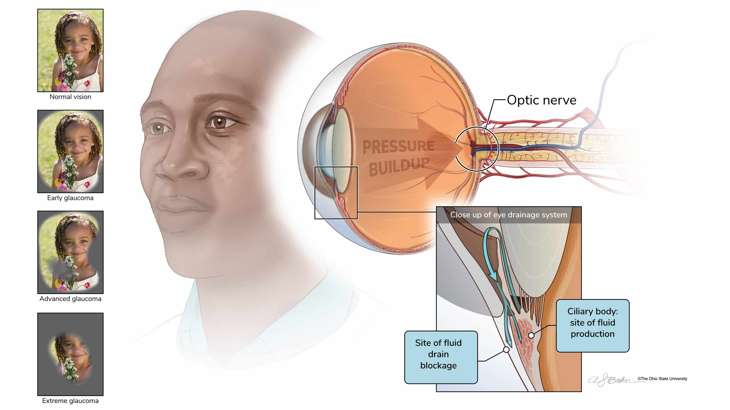 Illustration explaining how glaucoma affects the eye