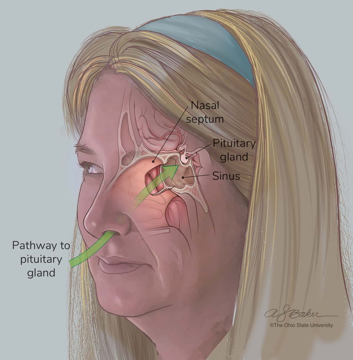 Medical Illustration detailing a skull base tumor
