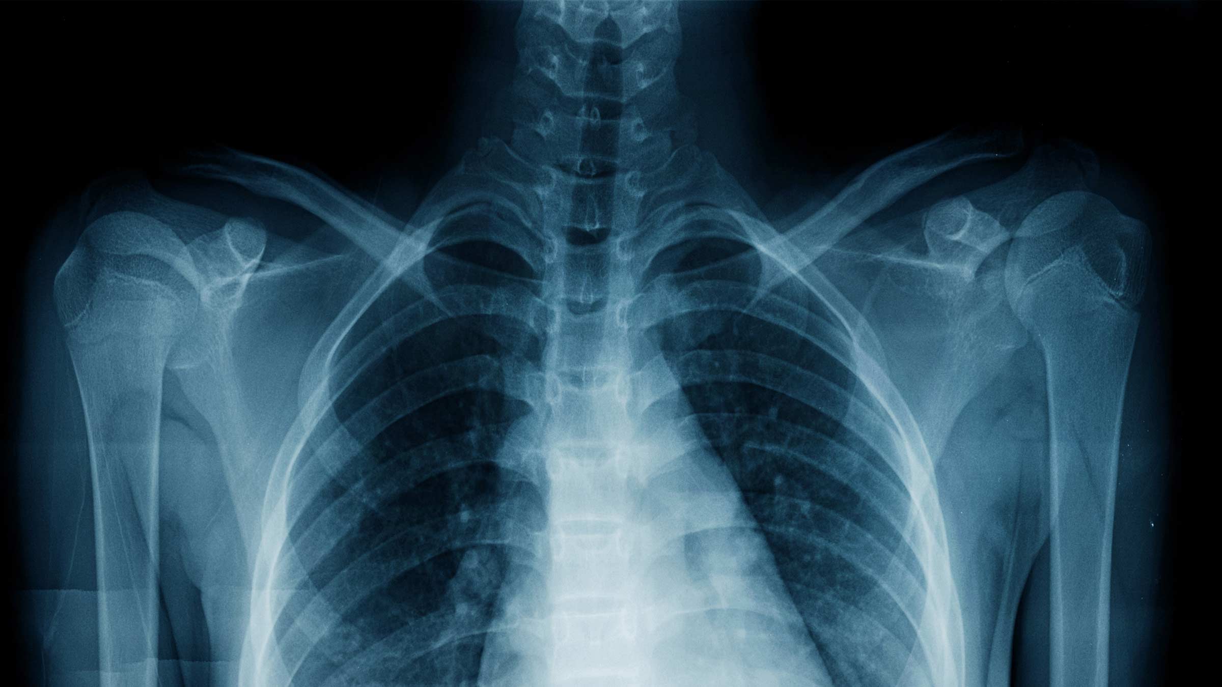 Close up image of a chest x-ray