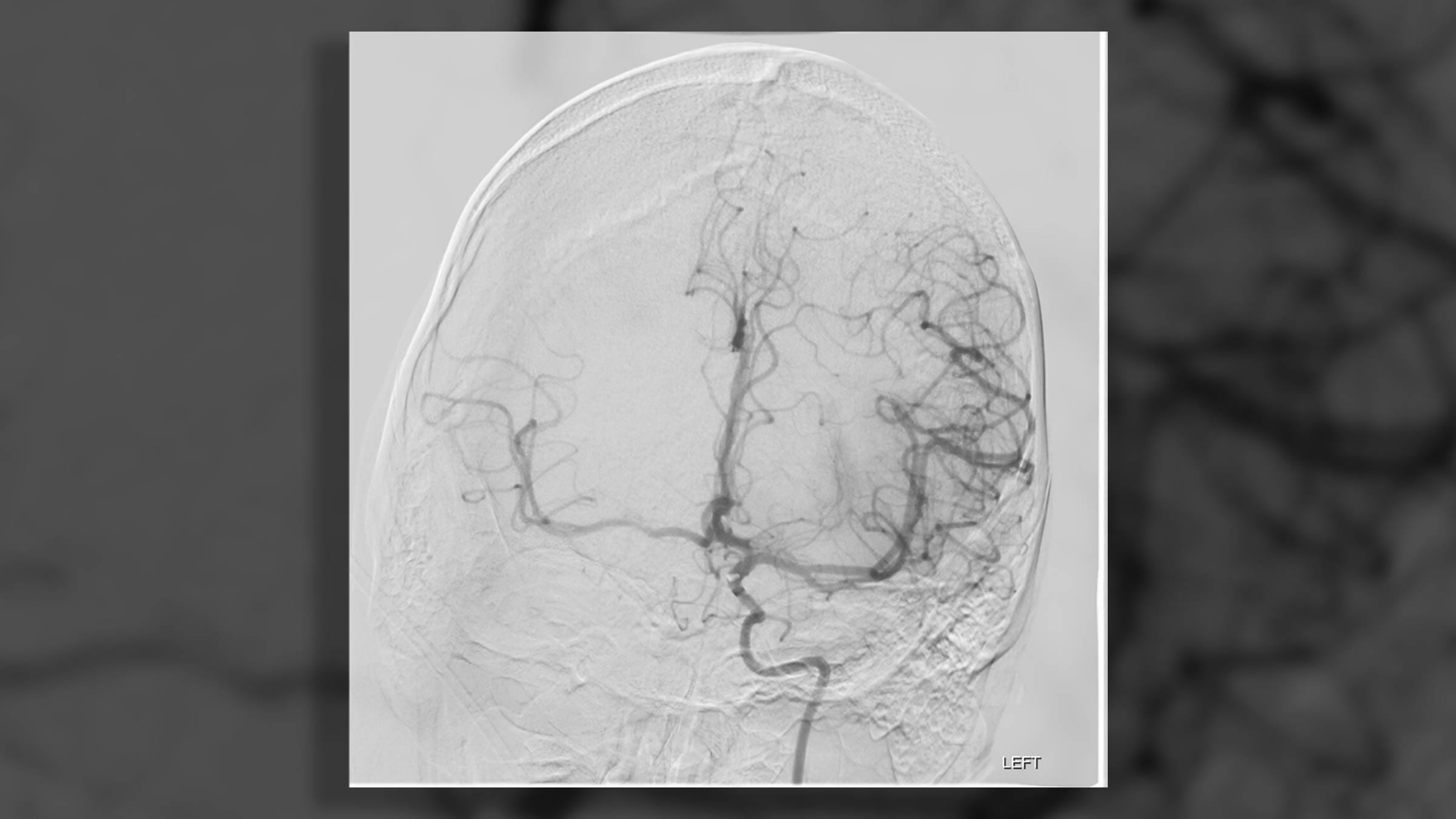 A CT scan and angiogramfrom during Stephen Vidman’s successful thrombectomy