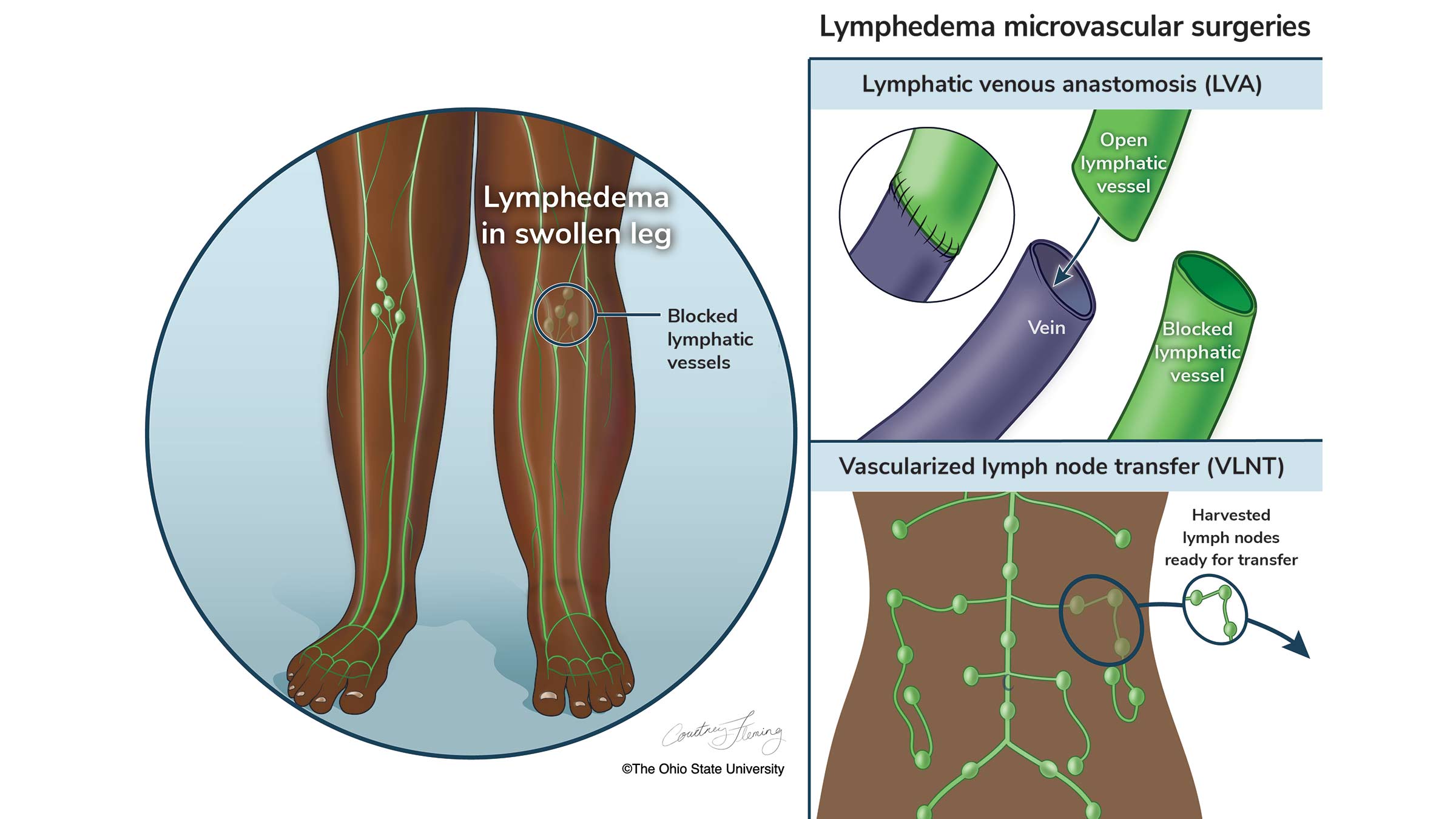 Lymphedema microvascular surgeries graphic illustration