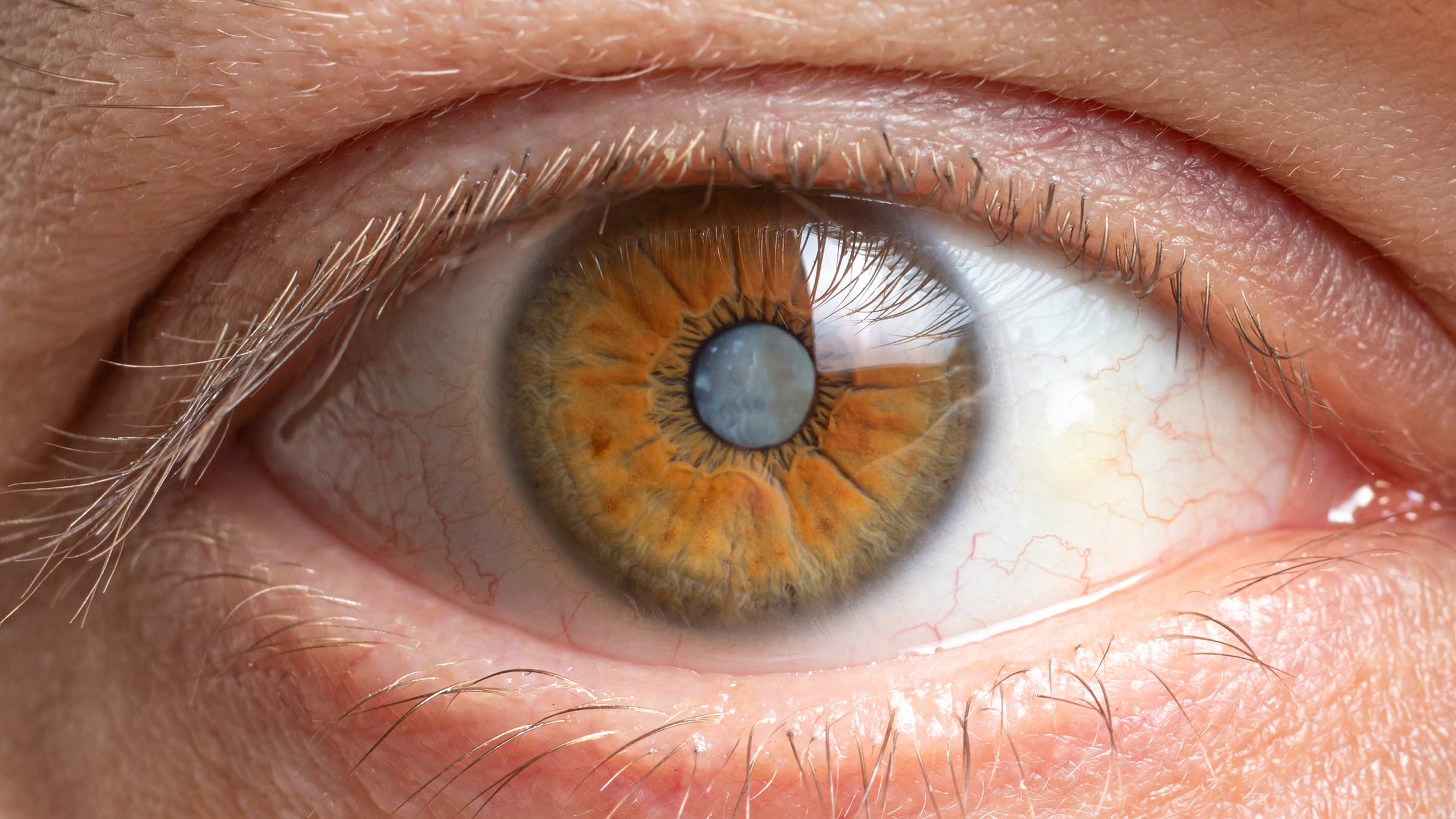Close up image of a human eye with a cataract clouding the eye lens