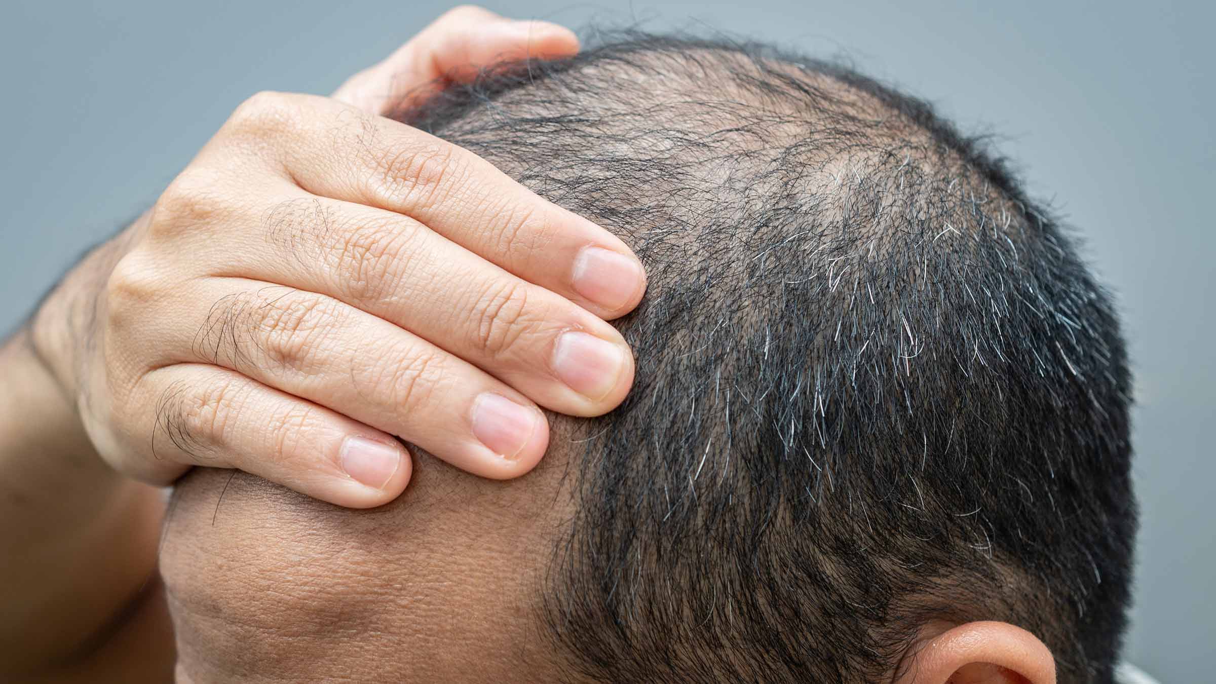 A close-up of a man touching his balding head