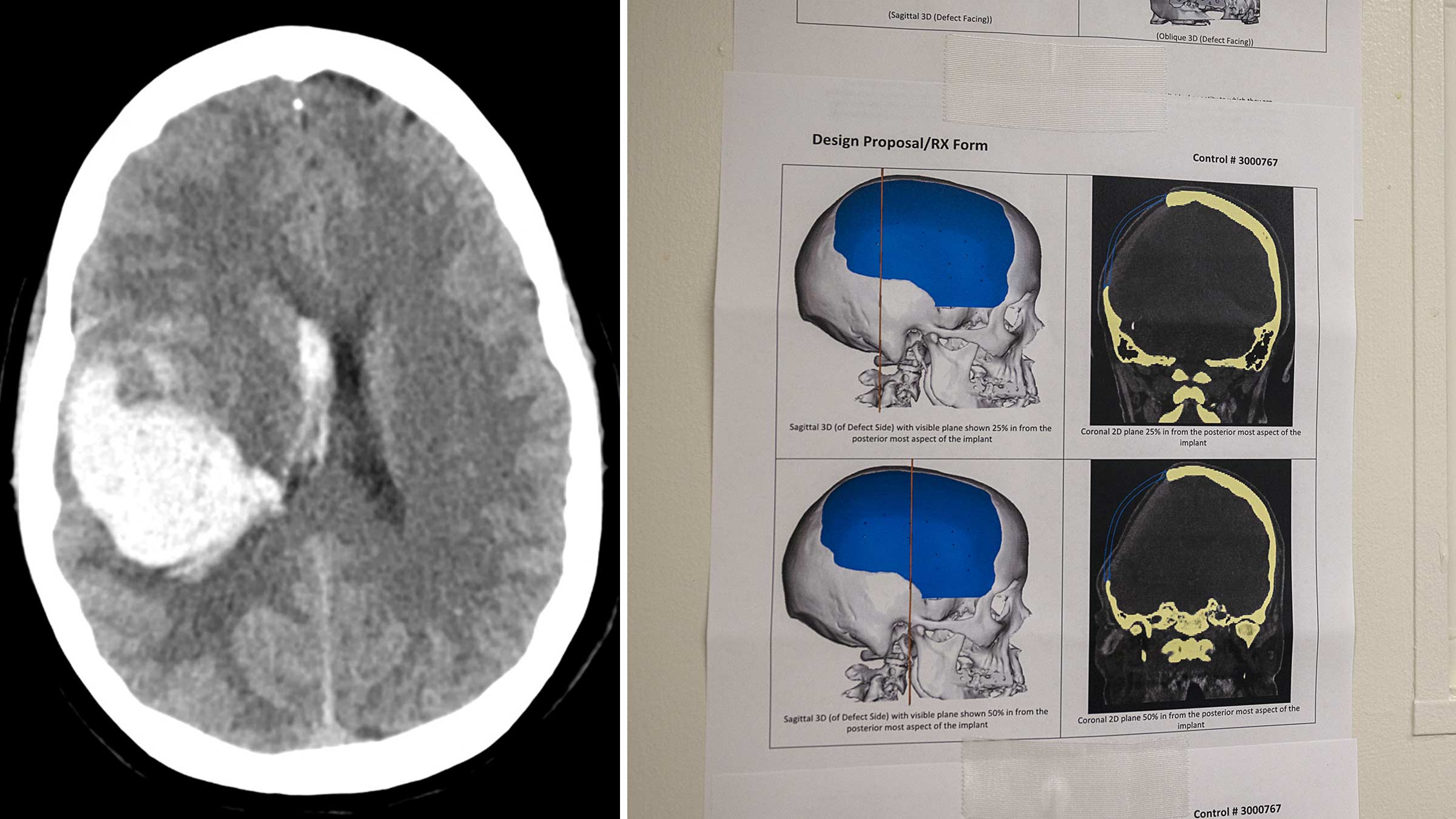 A collage of two images: Dr. Mitchell’s plan for a patient’s cranioplasty, and a patient's brain scan showing damage from a brain bleed