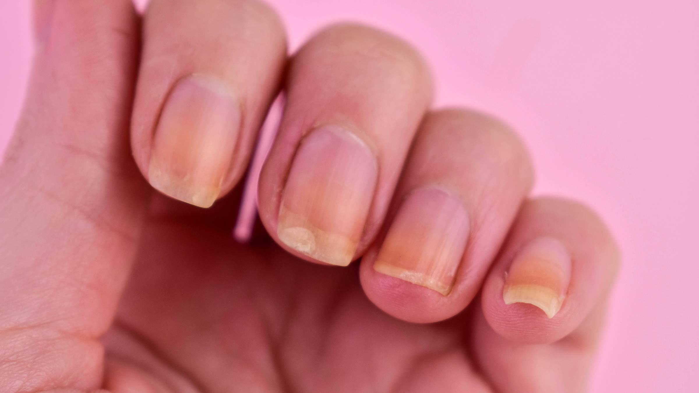 Damaged, yellowed fingernails on a woman’s hand against a pink background