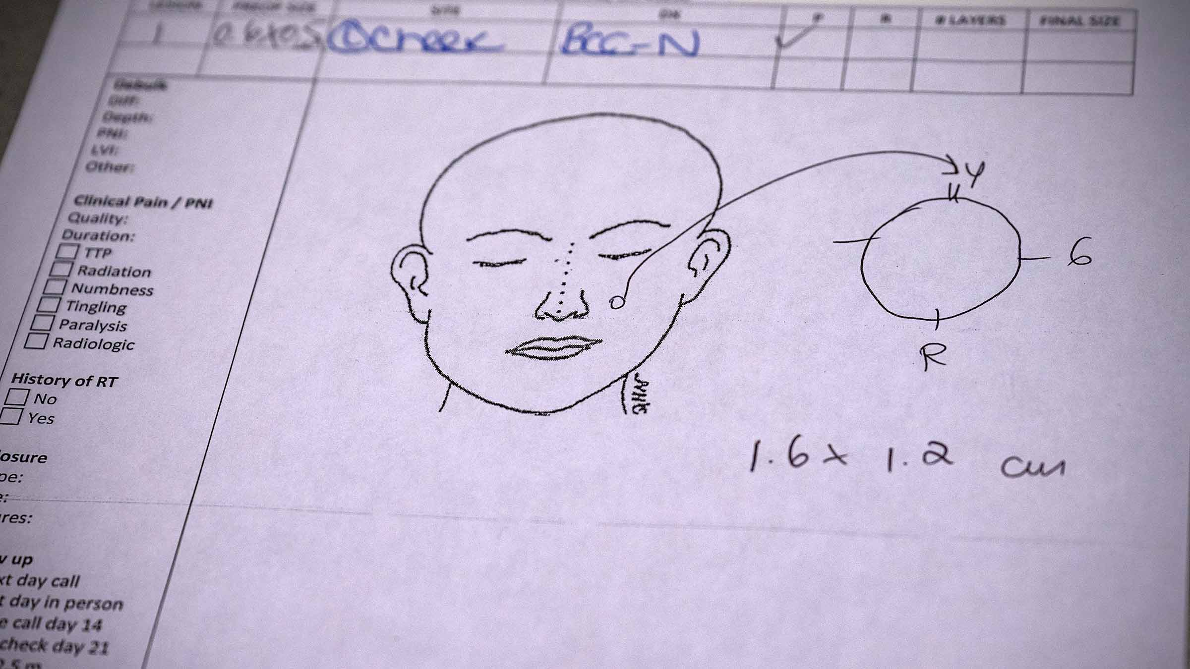 Diagram showing the size and location of the spot of the skin to be removed