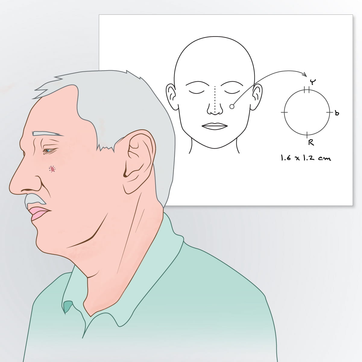 An illustration of the patient's face and a diagram of cancer location