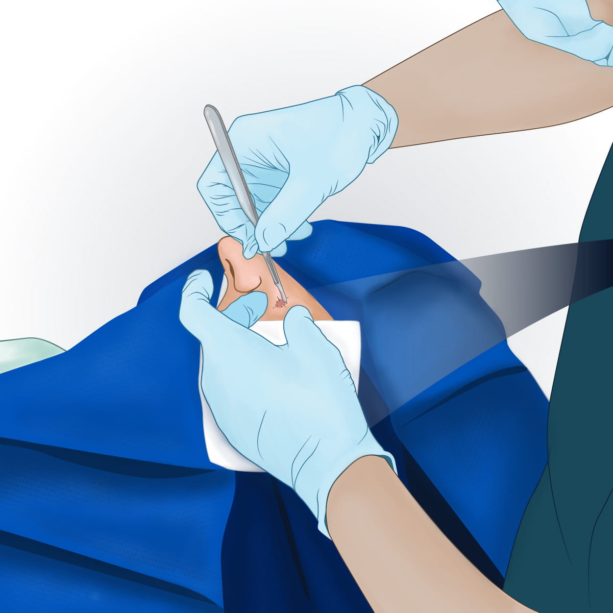 An illustration of a doctor removing the cancerous lesion