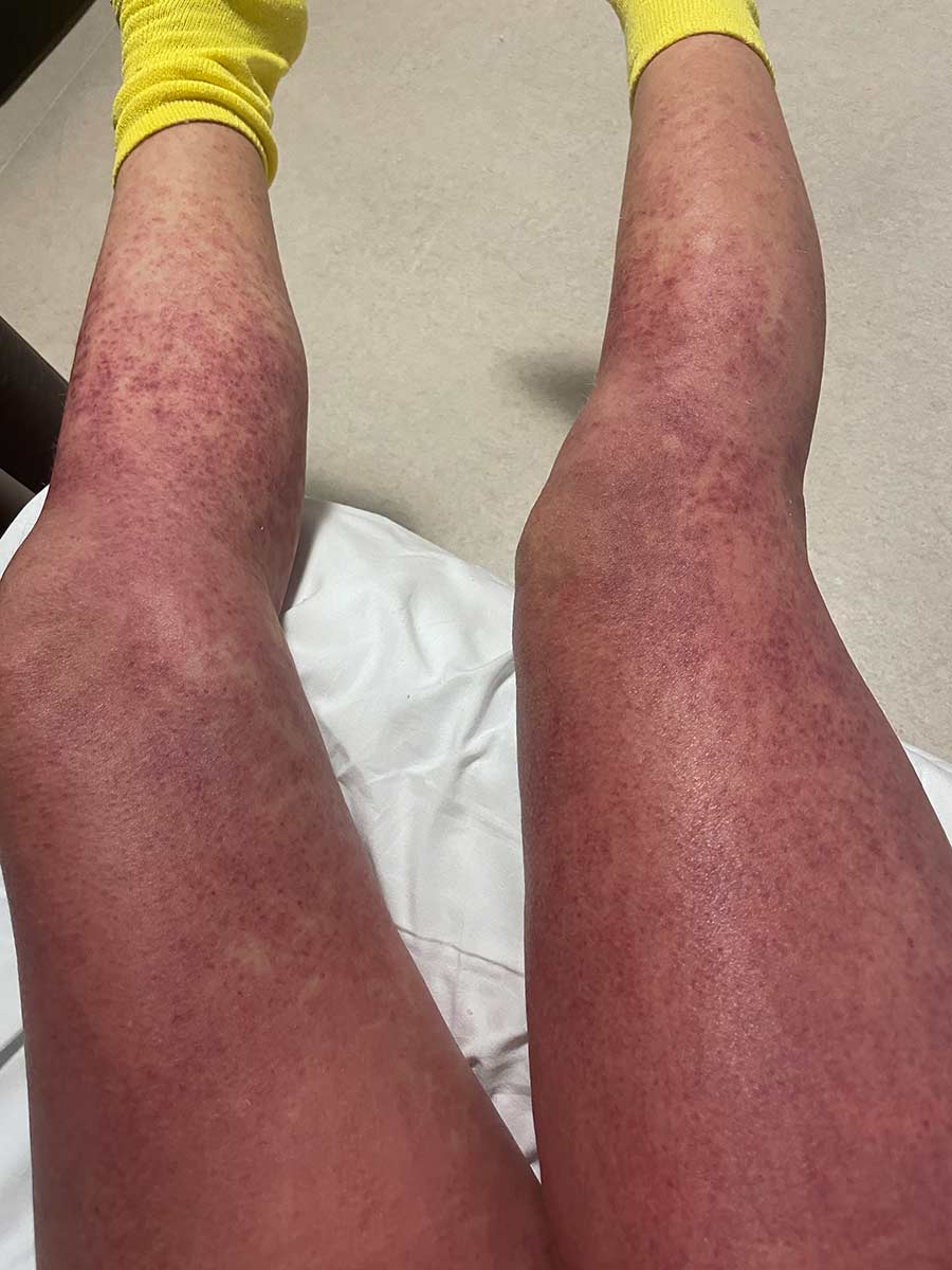 Sam de Silva’s legs covered in a red spotted rash