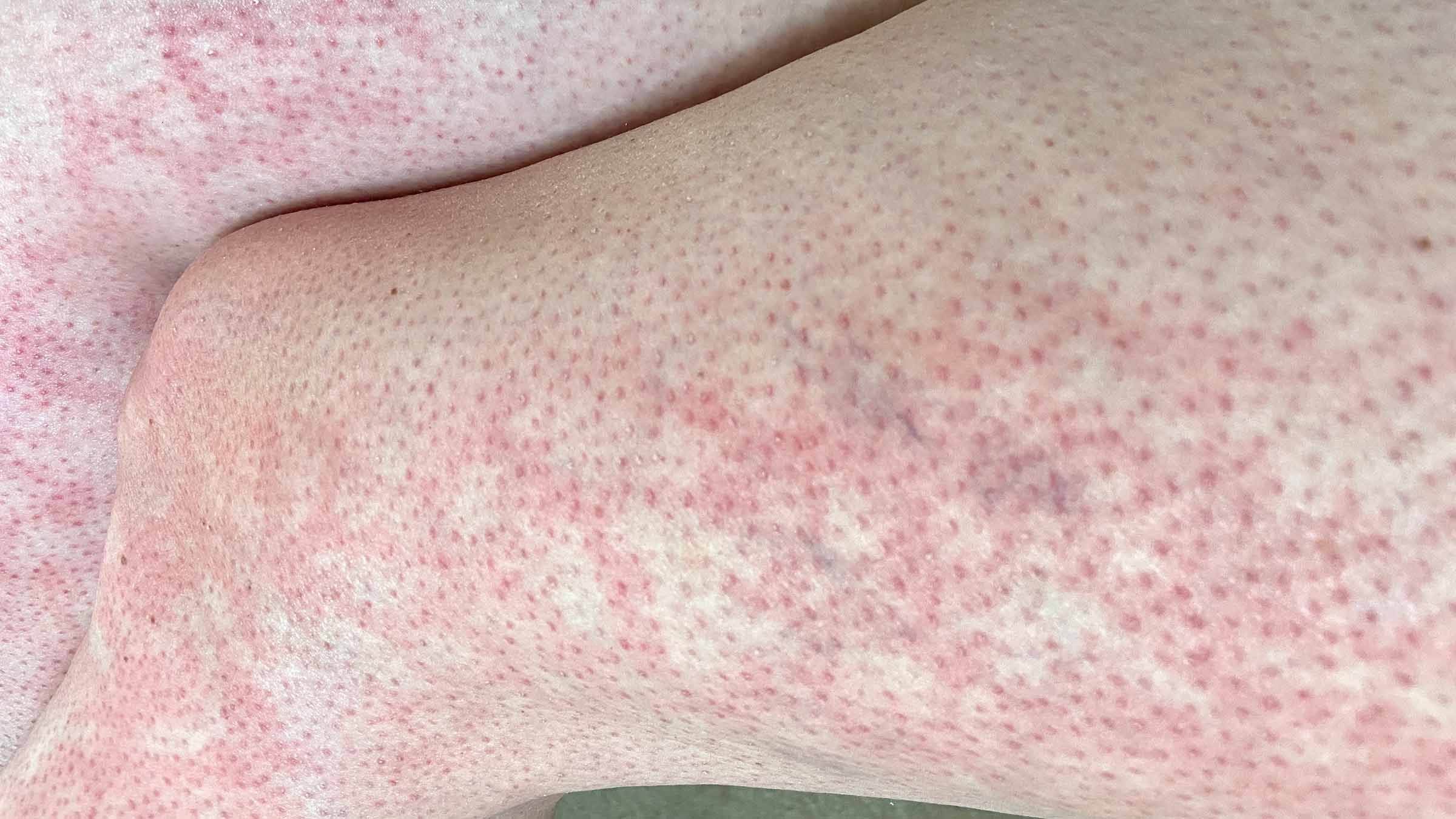 Can heating pads or space heaters cause ‘toasted skin syndrome’?