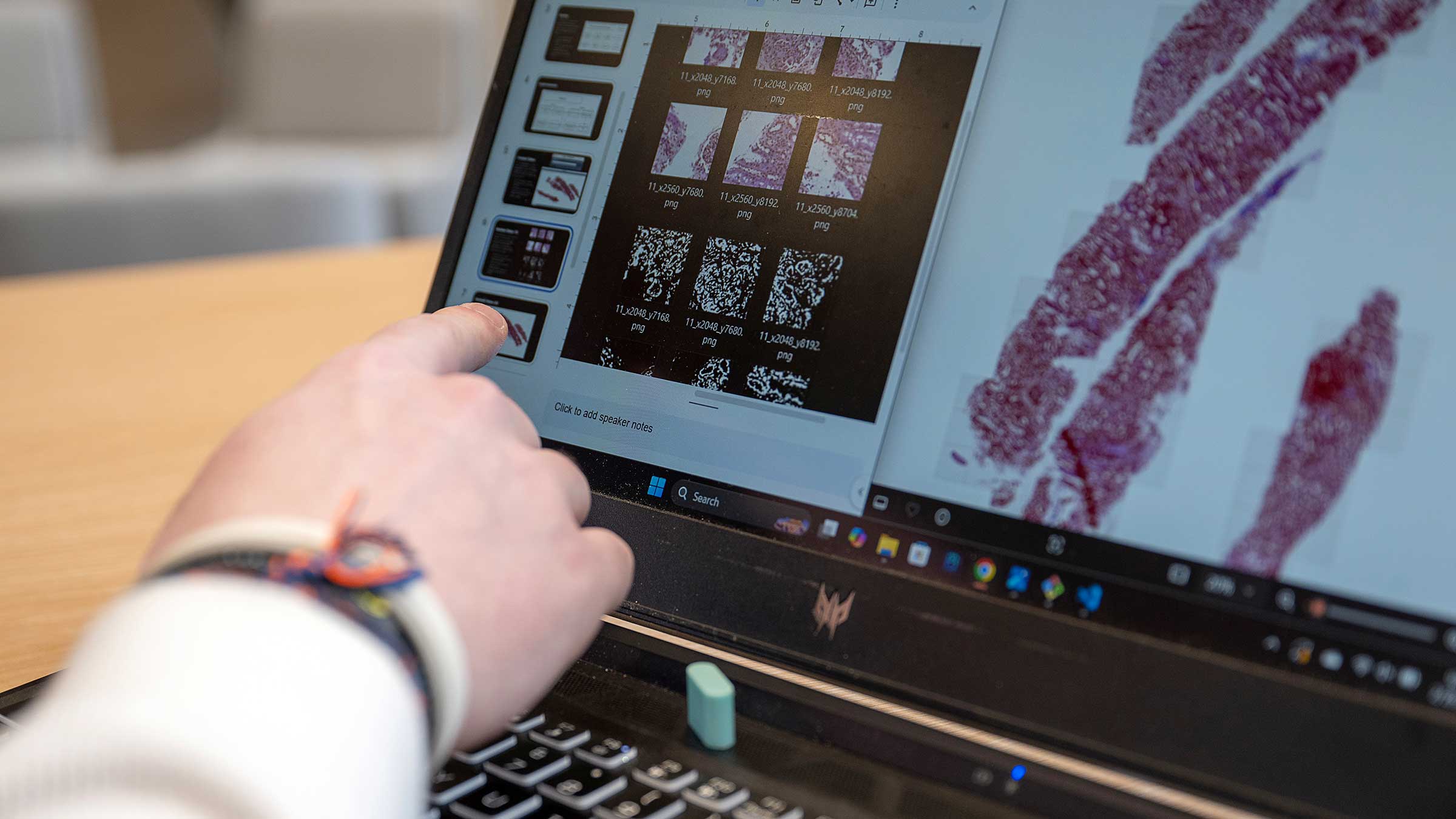 A laptop screen showing close-up, digital images of glomeruli