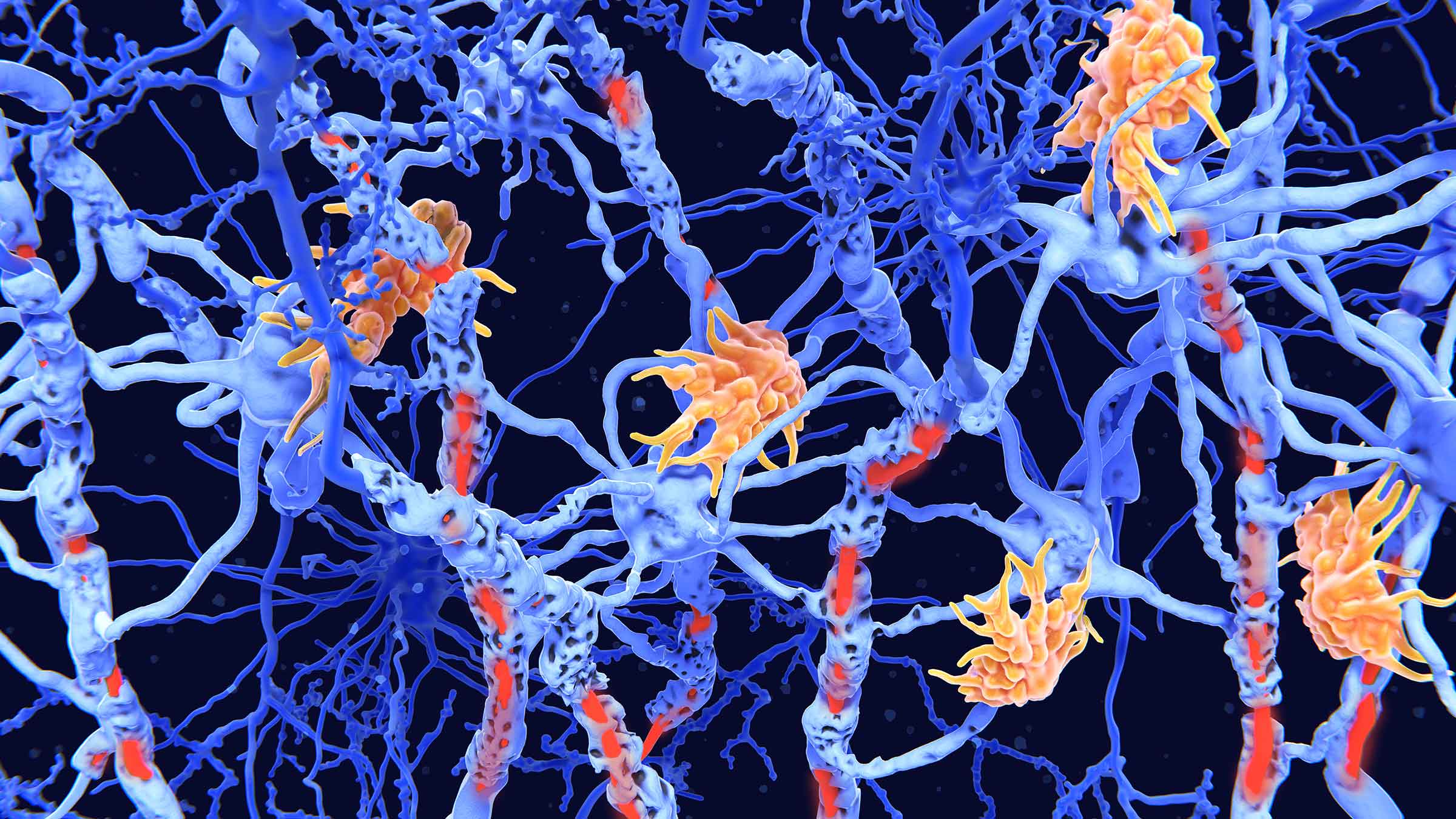 3D rendering of nerve damage in multiple sclerosis