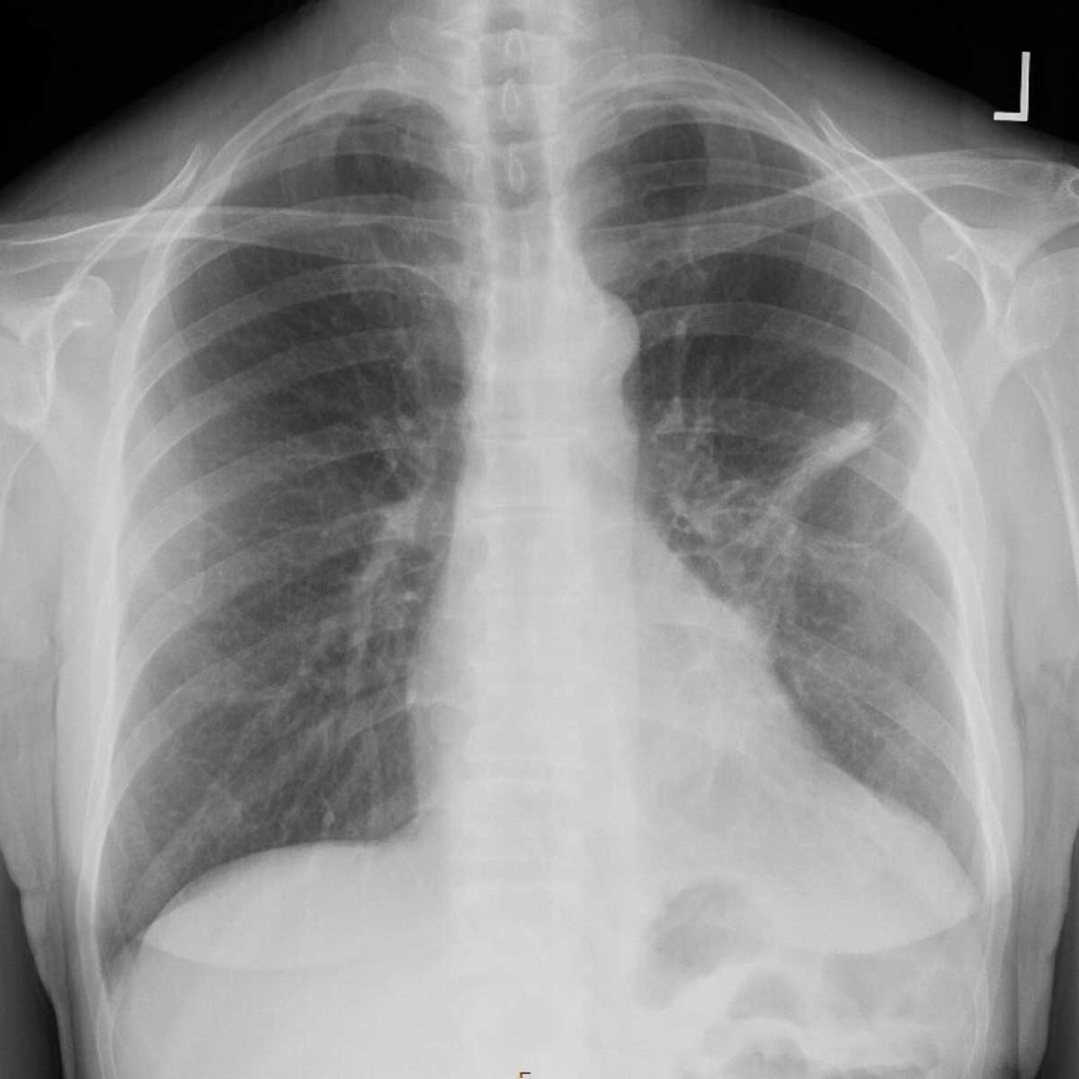 An x-ray scan of Laura Dehlendorf’s lungs after her procedure