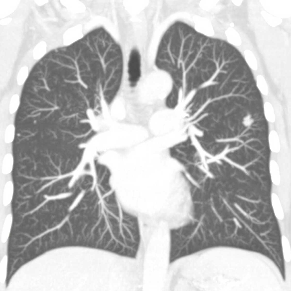 A scan image of Laura Dehlendorf’s lungs before her procedure