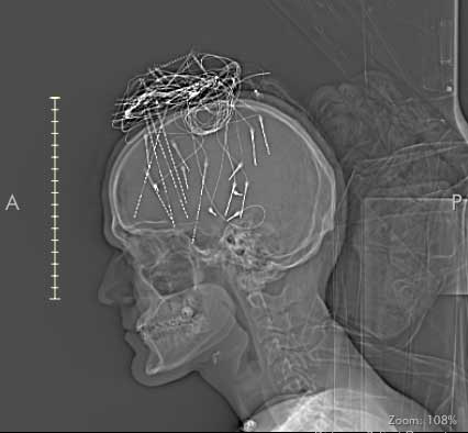 A scan of Noah Braholli’s brain showing tiny electrodes tracking seizure activity