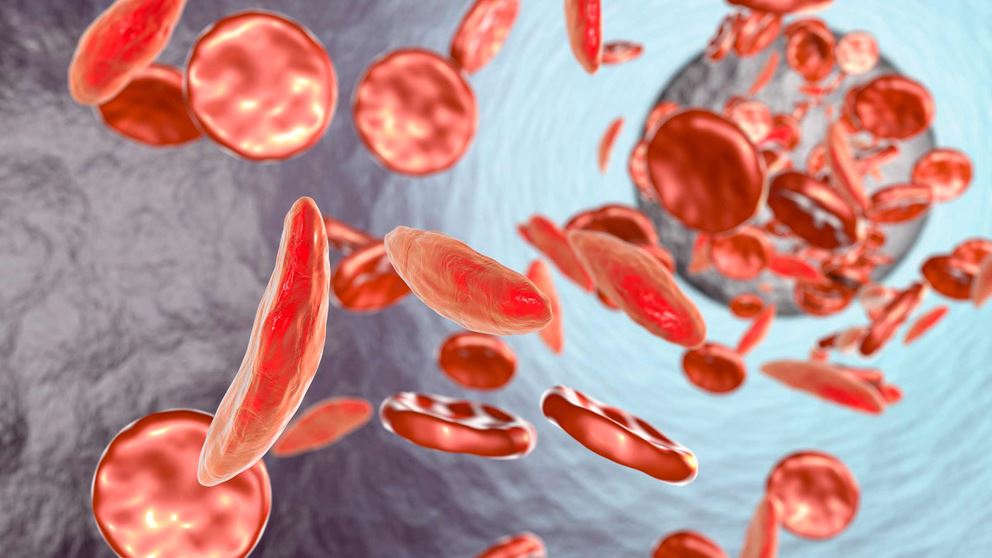 A close-up digital image of sickle cells in a blood stream