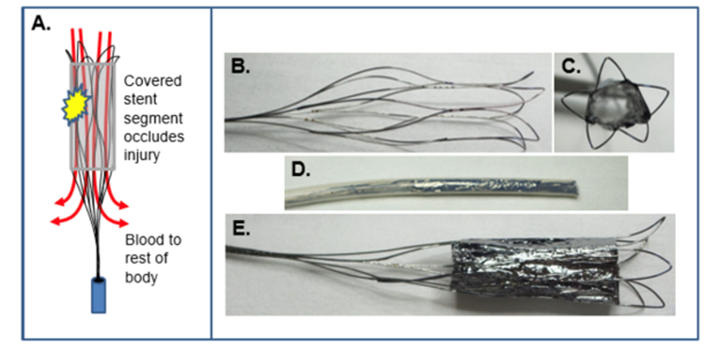 First version of the retrievable “rescue” stentgraft