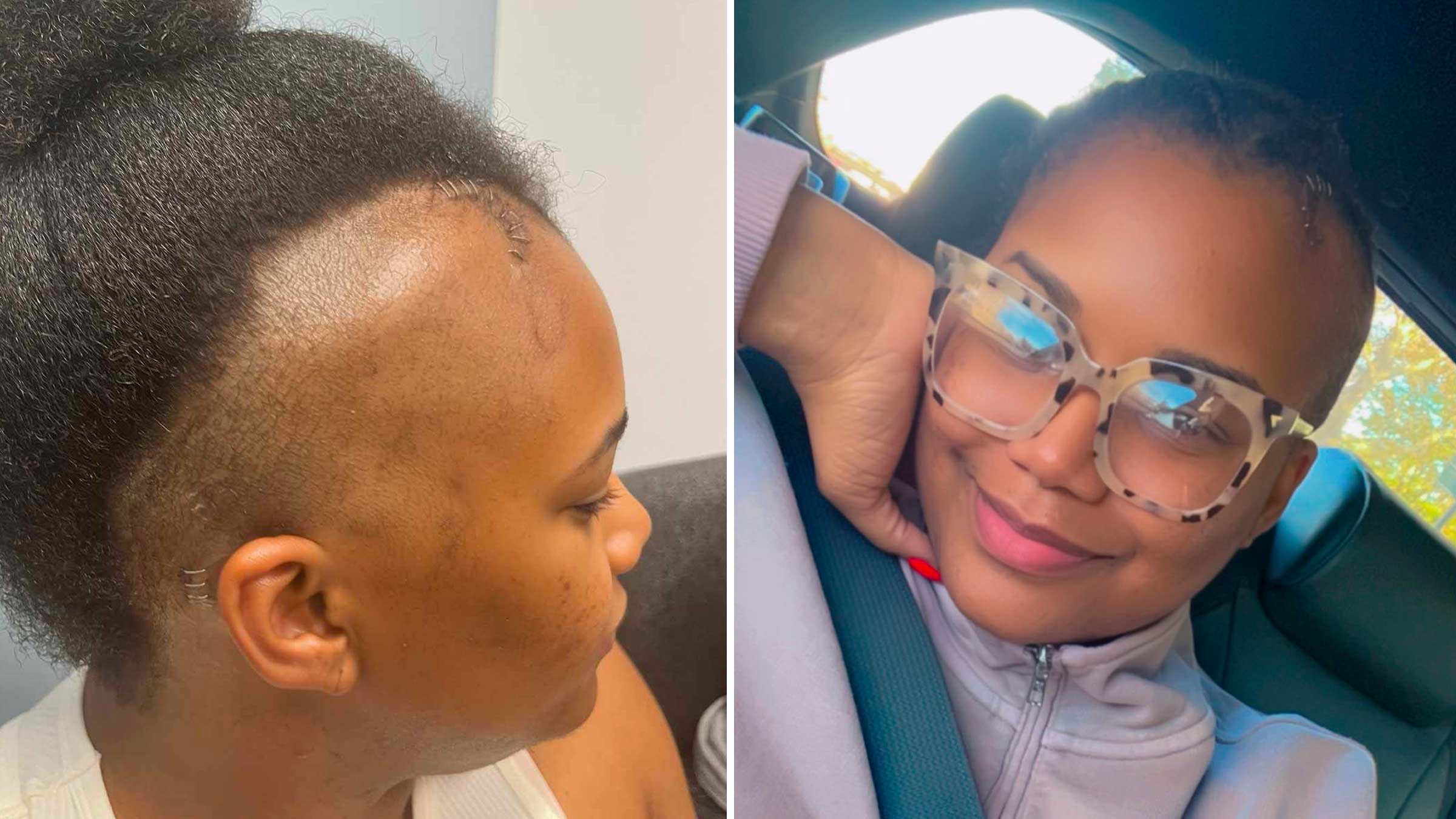 Collage of two photos showing NaAsiaha Simon's scars after surgery