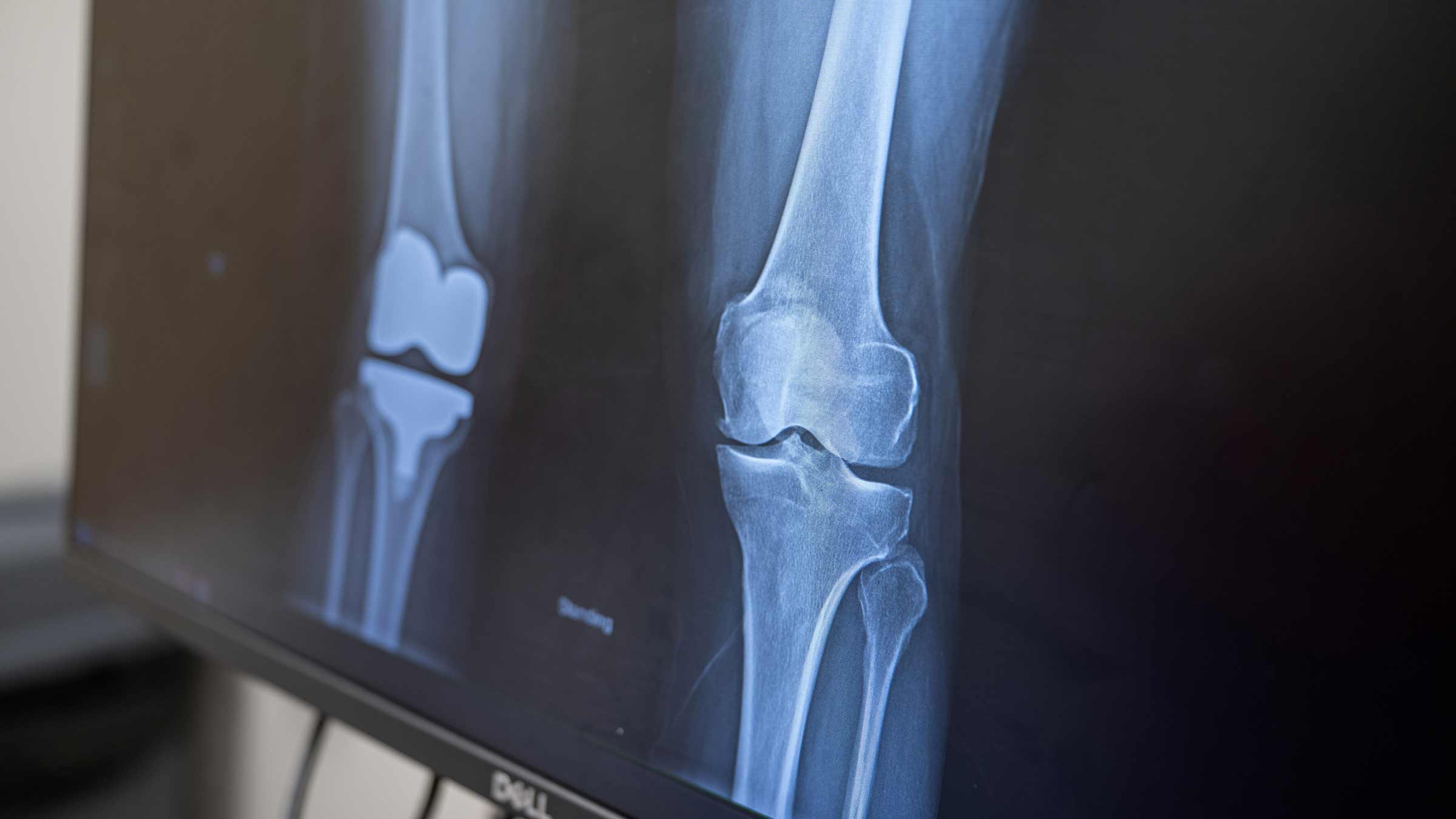 X-Ray with two knees