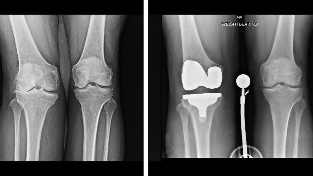 X-ray of Dr. Petri-Pickstone’s right leg before (shown on the left) and after a robotic-assisted joint knee replacement (shown on the right).