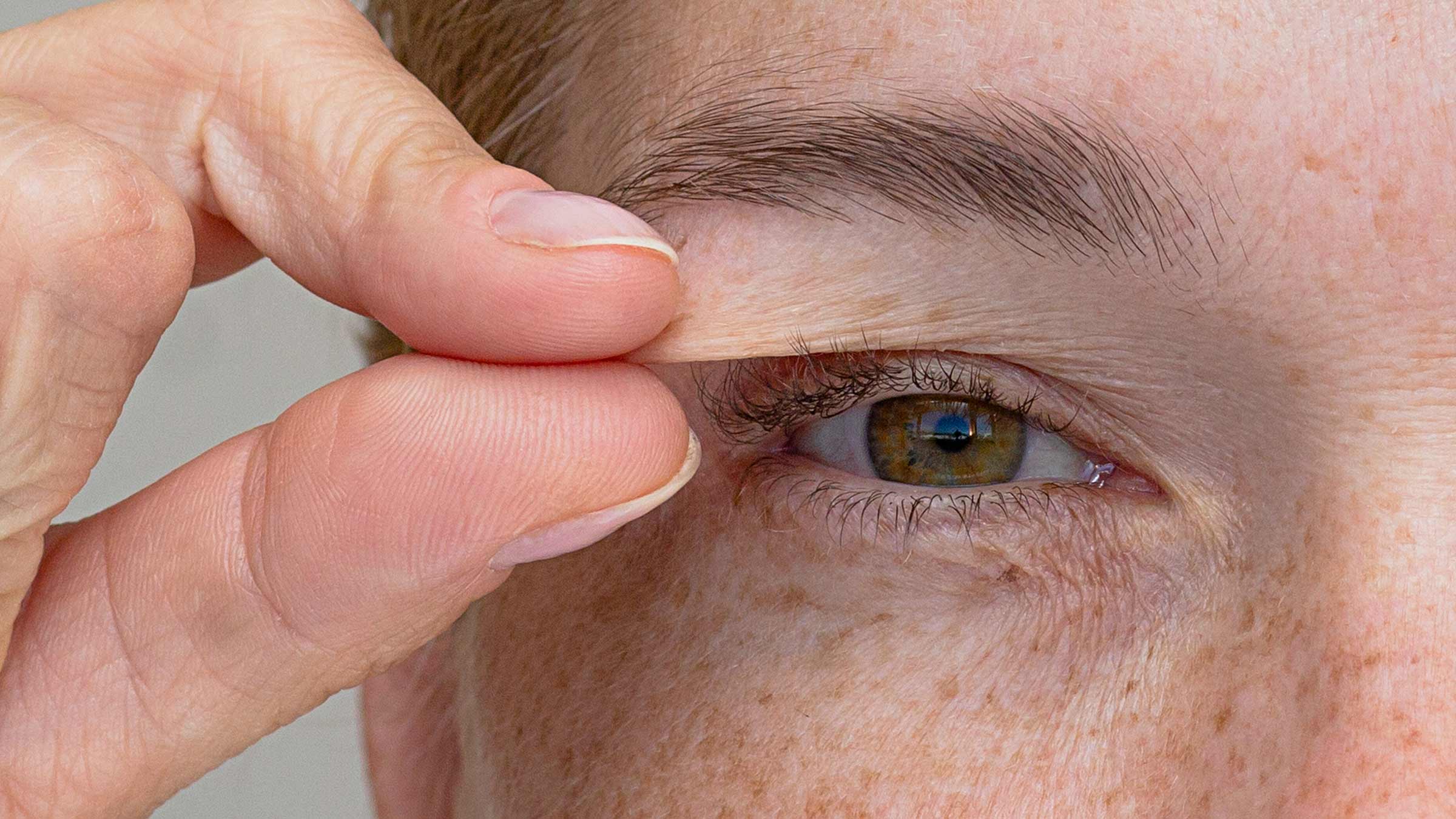 Blepharoplasty eyelid surgery: How to get a subtle, more rested look