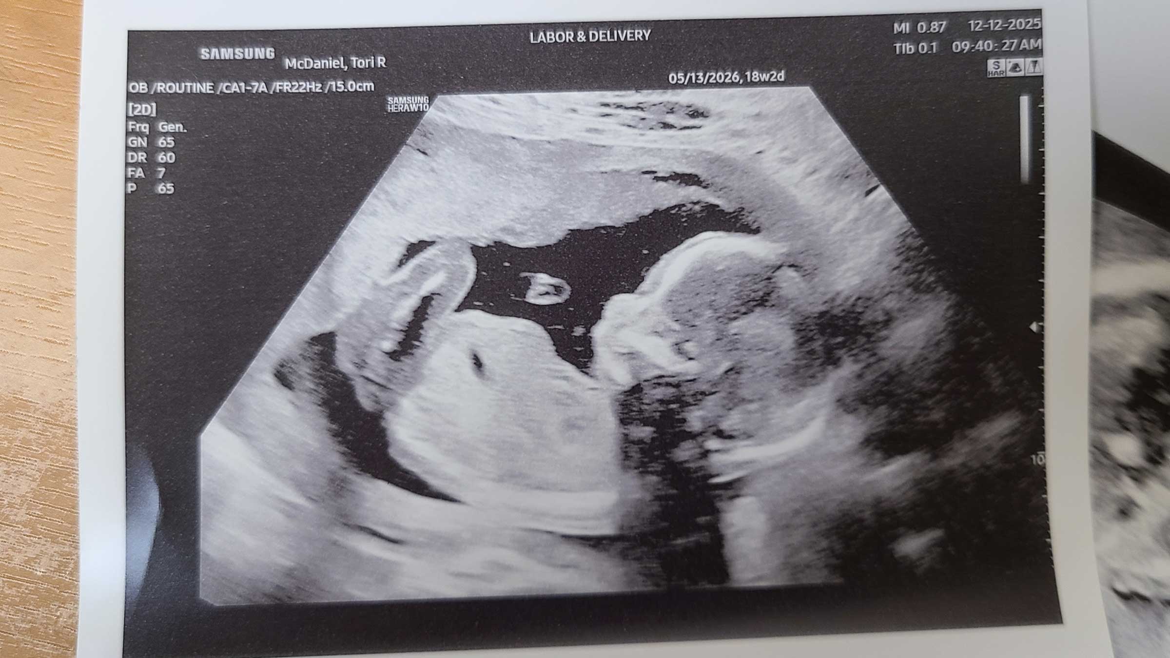 An ultrasound image of Isaiah McDaniel